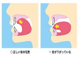 タングアップ